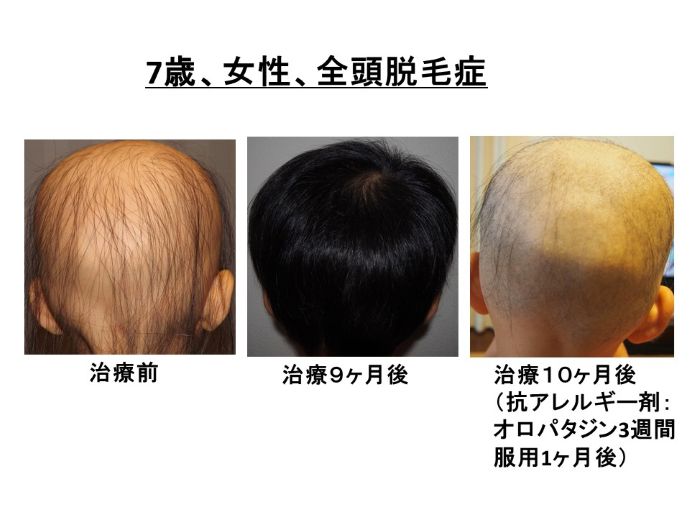 円形脱毛症　病院